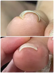 巻き爪ケア✯
