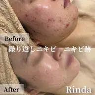 【土曜限定】剥離なしハーブピーリング!話題のクリスティーナ/ビオフィートで【繰り返しニキビを炎症鎮静】ケア
