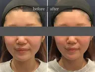 グッバイたるたる二の腕◆部分特化◆痩身 Lifit✕ラジオ波