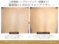 【ボディ1部位】≪剥離あり≫ヒト幹細胞ハーブピーリング