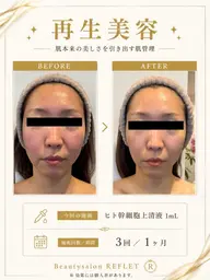 【再生美容】年齢肌・毛穴・ハリ不足に✨ヒト幹細胞上清液1mL導入
