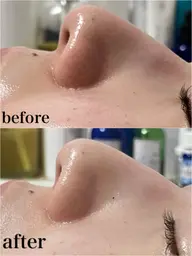 ✨人気No.1 ✨ミニモ限定 毛穴洗浄+イオン導入💆🏼♀️🩵肌改善体験コース