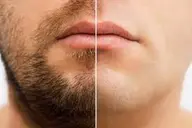 男性ヒゲ・顔脱毛