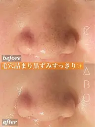 【平日限定】毛穴洗浄🫧【ハイドロフェイシャル】