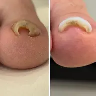 【10名限定❣️】モニター募集✨巻き爪でお悩みの方🦶