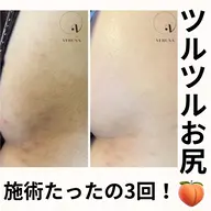 お尻のニキビ、黒ずみに!剥離有りハーブピーリング🌿