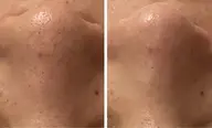 小顔フェイシャルケア+毛穴洗浄付🫧90分