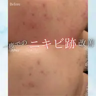 韓国最新🇰🇷進化版ダクトピーリング✨️