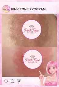 【バストトップのくすみケア】ピンクトーンバストケア初回