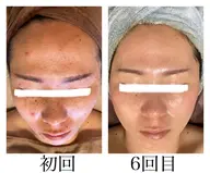 【温活デトックス×肌再生】剥離なし！REVIハーブピーリングとよもぎ蒸しセット🌿✨