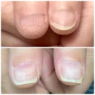 深爪育成(育成オイル付き)