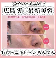【お肌改善】短時間水光仕上げ!Airプラズマ