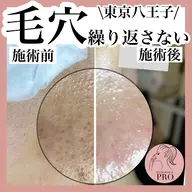 幹細胞ハーブピーリング🌿