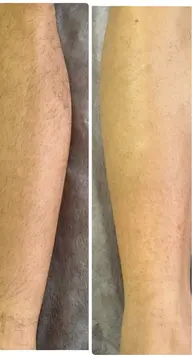 脚or腕 脱毛