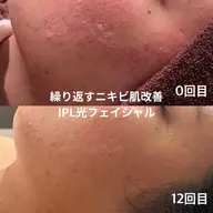 光フェイシャル|赤み・ニキビ跡・くすみ改善