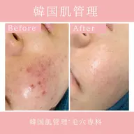 剥離なし！ハーブピーリングでニキビケア🫧
