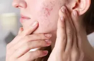 肌荒れケア体験​〜​まずはお肌と向き合う時間を​〜​ニキビ・アトピー敏感肌の方におすすめ