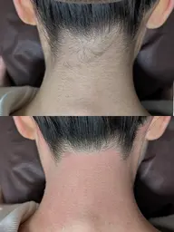 【魅せる✨後ろ姿美人】うなじWax脱毛