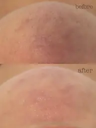 フェイシャルWax脱毛✨全顔
