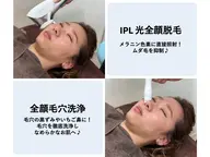 【毛穴洗浄＋全顔光脱毛】ツルツル！毛穴もムダ毛もキレイに♪黒ずみ鼻にも◎