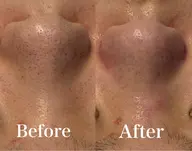 【先着3名限定！】毛穴洗浄体験🫧ツヤツヤお肌になりたい方にオススメ🧖🏻‍♀️🩵