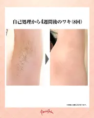 お試し🐚セルフ脱毛