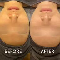 フェイシャルカスタムエステ(目隠しモニター)