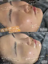 現金のみ⚠️ 【モニター様募集/口コミ必須】韓国肌管理×ララピール(鎮静マスク付)