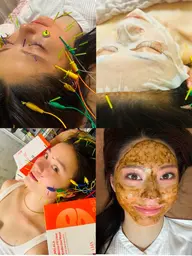 本格変化【ニキビ肌荒れ即変化🤍【超高濃度炭酸パック→電気美容鍼✖️無剝離ハーブ🌿orララピール】学生−1000円