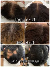 【初回体験価格】 鬼育毛促進鍼/抜け毛/薄毛/細毛/円形脱毛症￥27500→ ￥5980