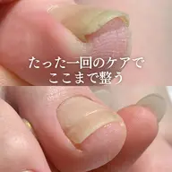 【痛みの少ない】巻き爪ケア(お試し)