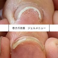 フットのお休み期間に! 【巻き爪改善ネイル】 親指2本¥2000