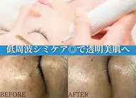 💎20分間シミ取り放題💎お肌に優しい低周波シミ取りで薄いシミも濃いシミも1週間でポロッと剥離◎