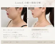 🚨先着2名様限定【肌質改善・小顔矯正・脂肪コントロール・毛穴洗浄・フェイスワックス・ブライダル】2つ選べる‼️