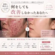 【何をしても改善しなかった方へ】刺激ゼロで肌を休ませながら改善|最後に選ばれる重度ニキビ特化ケア🔥
