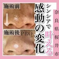 毛穴ケア【プレミアム】ヘッド+デコルテ付