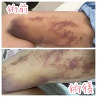 【部位写真+口コミ必須】整形・脂肪吸引後の拘縮・むくみ緩和に✨術後DTインディバ 30分