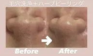 🌟ご新規様限定🌟【毛穴洗浄+ハーブピーリング】 黒ずみ/開き毛穴汚れスッキリ!ツルツルで触りたくなるお肌へ🪞✨