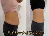 徹底痩身✨ハイパーナイフ＆強カリンパたった1回でこの効果！セル脂肪溶かす➕むくみ徹底改善🦋