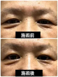 やればやるほど整形超え!プラズマシャワー【リブセラ】フェイシャル トライアル