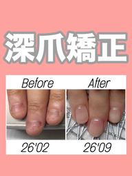 深爪矯正【長さ出し】◆カラーなし◆(オフ込)むしったり割れたり噛んで小さくなってしまった爪も美しく綺麗な状態に✧︎