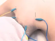 【リピーター割】 電気美容鍼 + 全身鍼灸 + お悩みに合わせた整体 (首肩こり 不眠 自律神経調整)