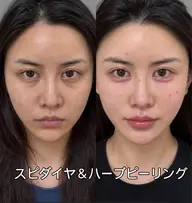 一回で驚き！✨［初回限定］韓国話題の最新美容！水光肌へ✨スピダイヤ＆ハーブピーリング★肌質改善ツヤUP 80分