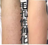 10/9まで!《モニター限定》剥離ありExsハーブピーリング足90分(表太もも、裏太もも、すね、ふくらはぎ)から1箇所