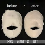 小顔人気No,3 【立体小顔】小顔コルギ石膏パックxデコルテマッサージ