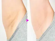 【黒ずみ美白脱毛】脇ピーリング脱毛2回分