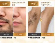 【メンズ脱毛】men'sヒゲ脱毛