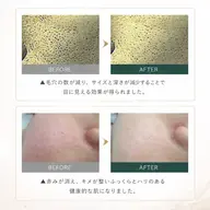 【韓国肌プログラム】肌を育てる次世代トリートメント◇メソプロプラス