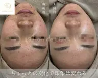 ✨🌿ミニモ学割🌿✨💎人気No.2肌質改善‼️剥離なしハーブピーリング💎