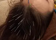 【頭皮のコリ・自律神経乱れ(不眠)・髪のハリやコシ・育毛には頭皮鍼🪡💆🏻‍♀️】ヘッドマッサージ付
